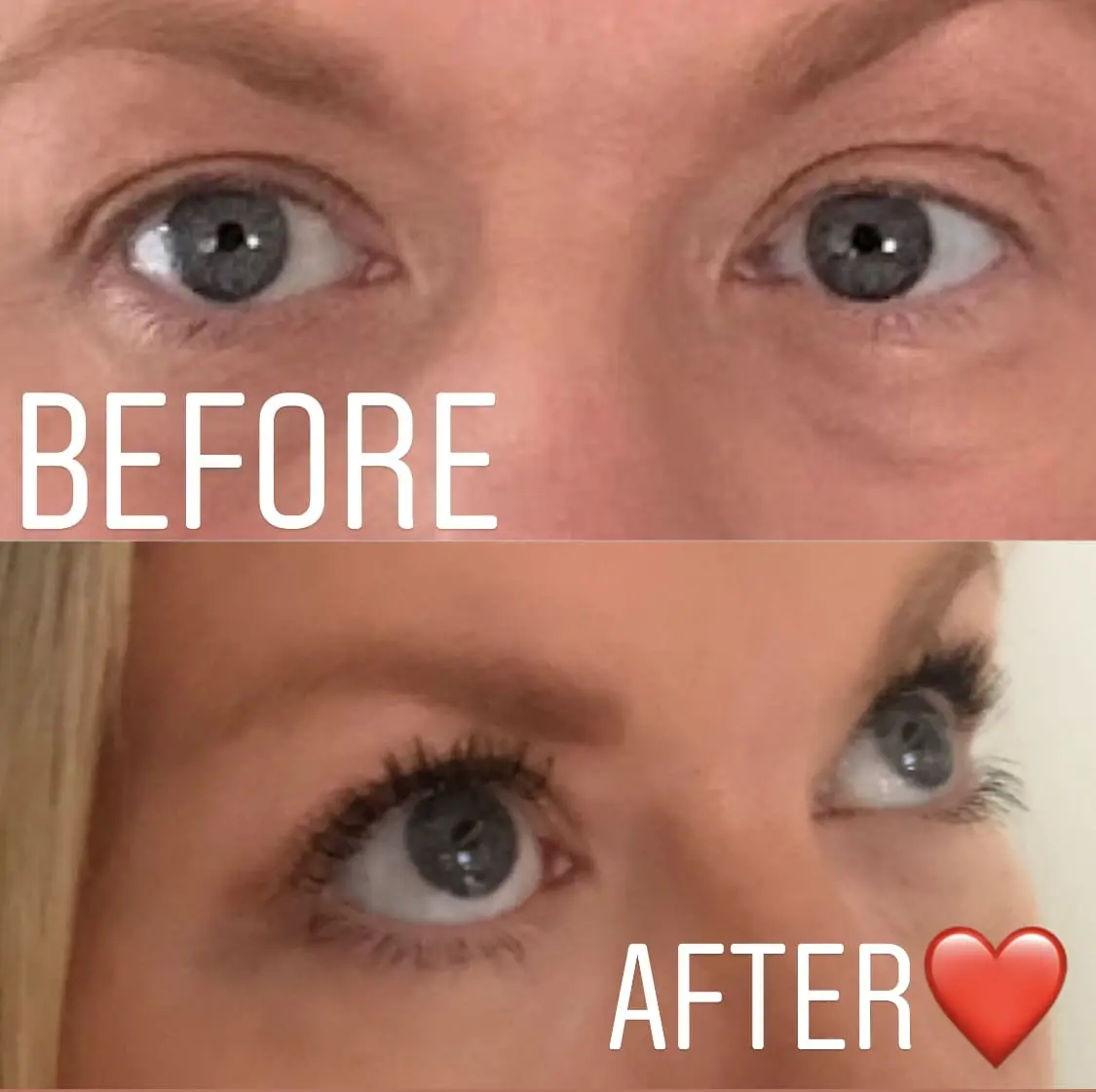 before and after image of an eye lifting 